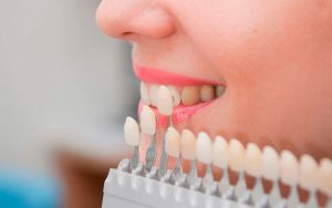 Facetas dentárias: como conquistar o sorriso perfeito