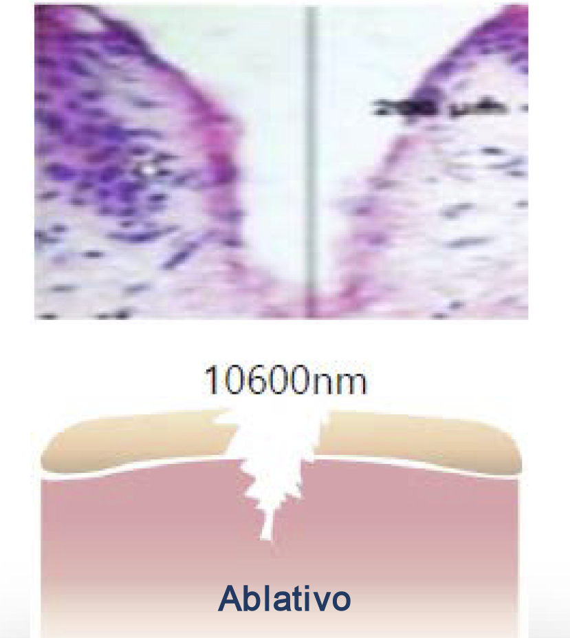 dra-tania-siqueira-guarulhos-cirurgia-lavieen-bb-laser-ablativo