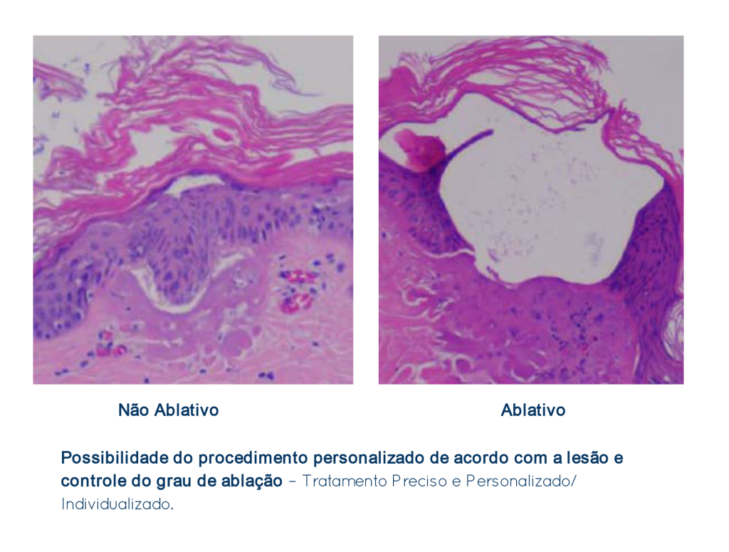 dra-tania-siqueira-guarulhos-cirurgia-lavieen-bb-laser-ajuste-da-ablação