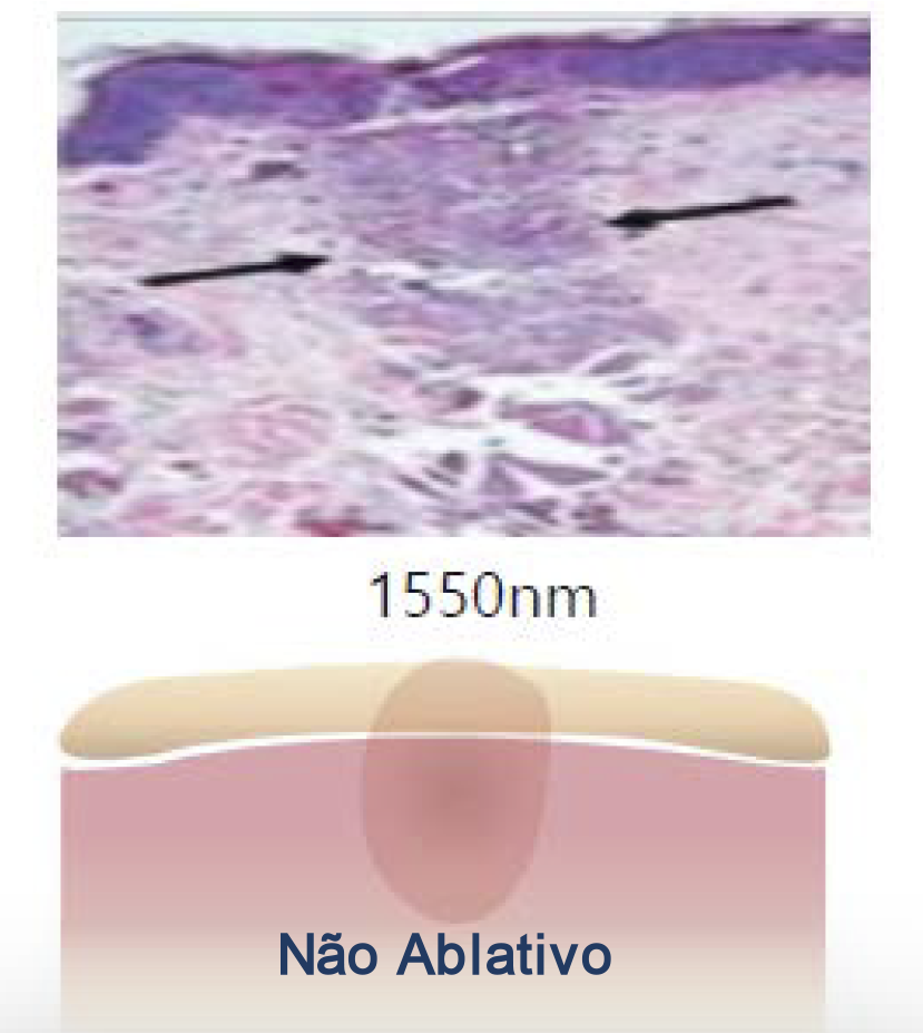 dra-tania-siqueira-guarulhos-cirurgia-lavieen-bb-laser-nao-ablativo