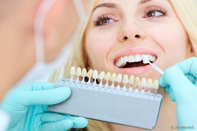 Descubra os Benefícios das Lentes de Contato Dental para a Estética Dentária
