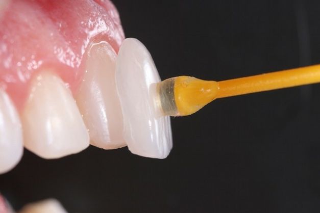 Entenda Como Funcionam as Lentes de Contato Dental: Um Guia Completo
