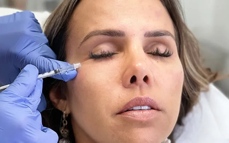 PREENCHIMENTO AVANÇADO COM ÁCIDO HIALURONICO curso dra tania