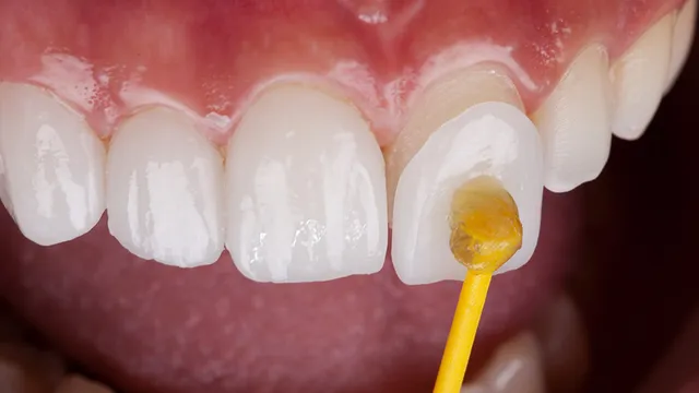 Por que as Lentes de Contato Dental São a Escolha Certa para Melhorar seu Sorriso