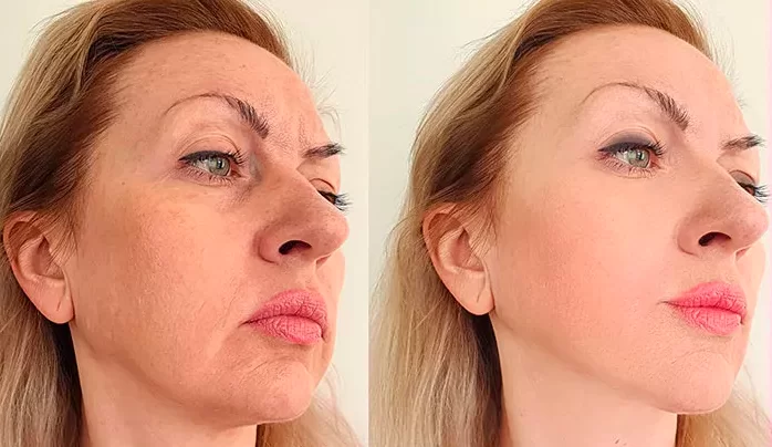 22. Lavieen: Preenchimento Facial com Resultados Naturais e Duradouros.